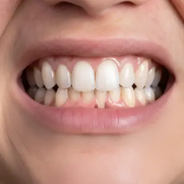 Diş Eti Hastalıkları Diş Eti Hastalıkları