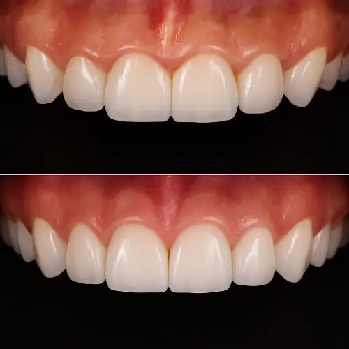 Kanal Tedavasi Kanal Tedavasi