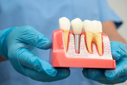 İmplant Uygulamaları 