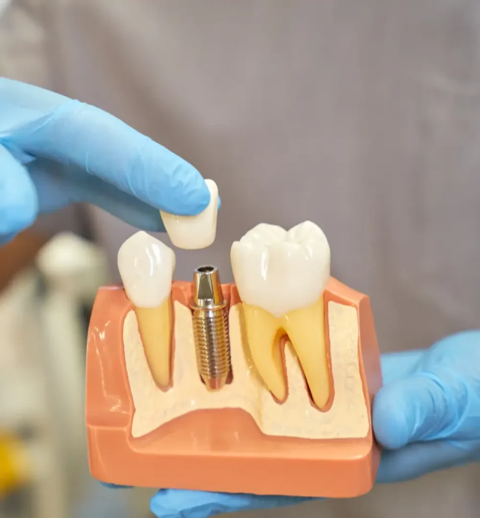 İmplant Ömrü Ne Kadardır? Yerli İmplant Ömrü Blog İmplant Ömrü Ne Kadardır? Yerli İmplant Ömrü Blog