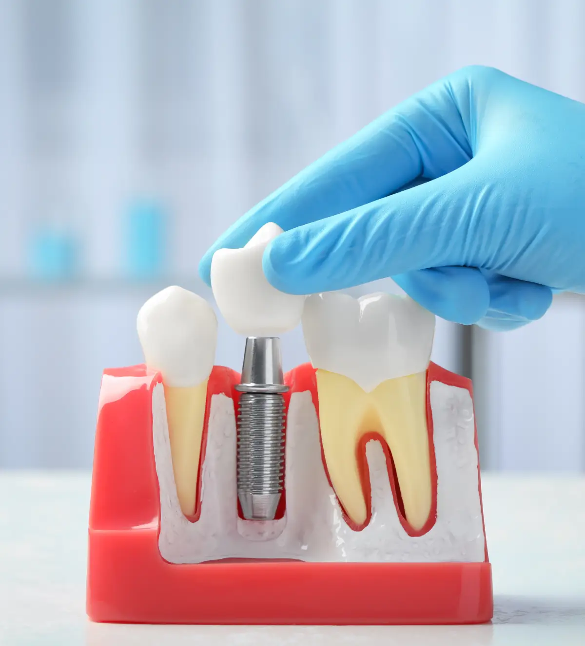 İmplant Ömrü Ne Kadardır? Yerli İmplant Ömrü Blog İmplant Ömrü Ne Kadardır? Yerli İmplant Ömrü Blog