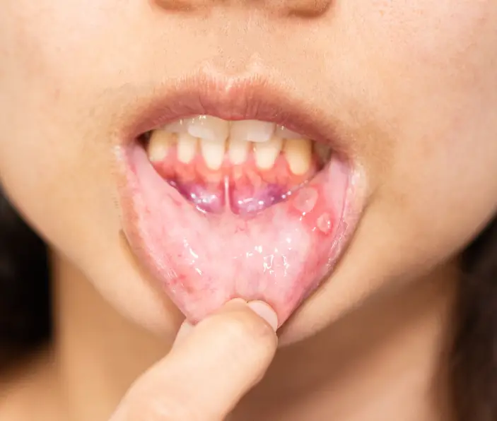 Aft Neden Olur? Blog Aft Neden Olur? Blog